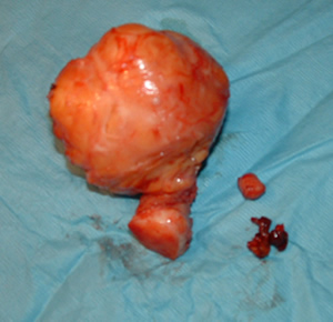 DEFINITIONS OF FIBROID